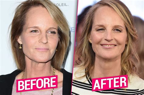 helen hunts facelift|has helen hunt had surgery.